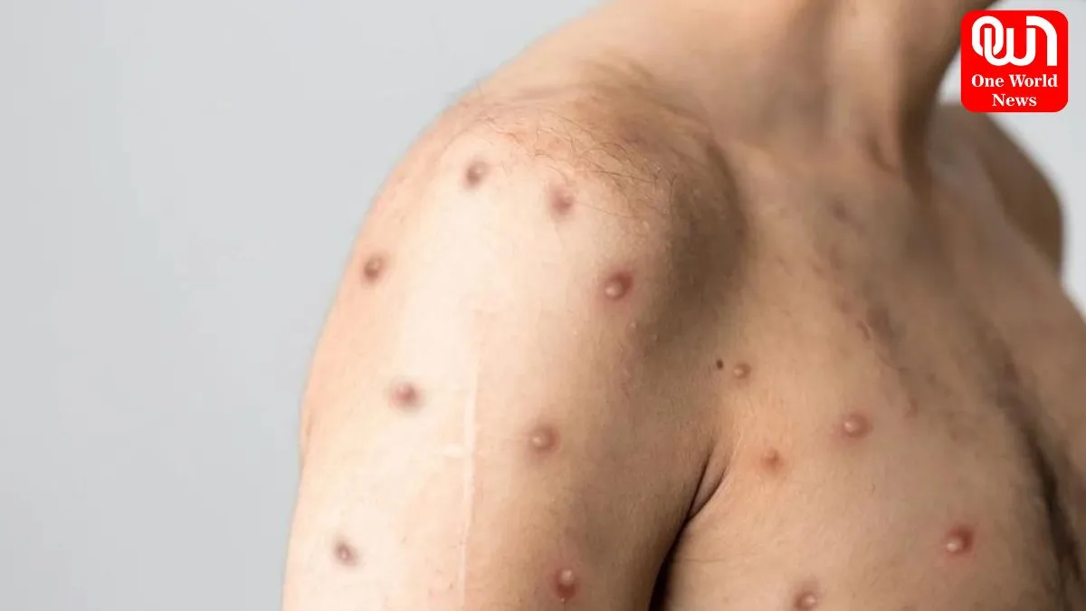 Chickenpox, Smallpox और Mpox, तीनों के बीच में क्या अंतर है? 1 Chickenpox_-Smallpox