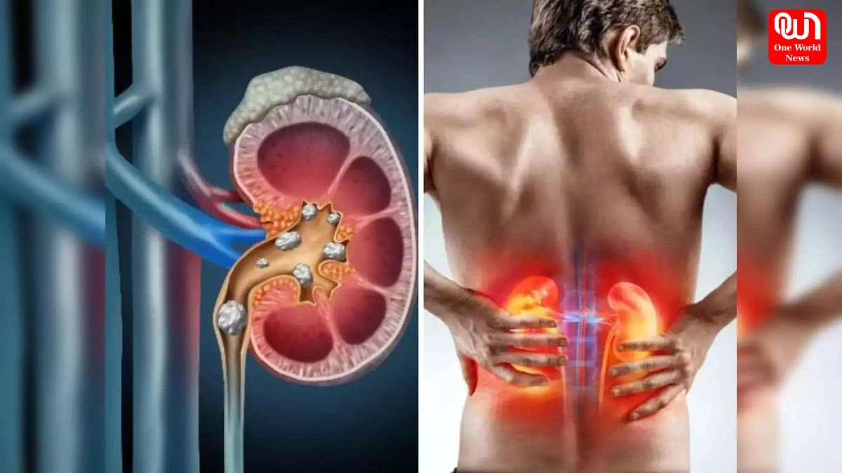 kidney stone : पथरी के मरीज ना खाएं ये 3 खाद्य पदार्थ, किडनी स्टोन की समस्या हो सकती है गंभीर 1 kidney stone