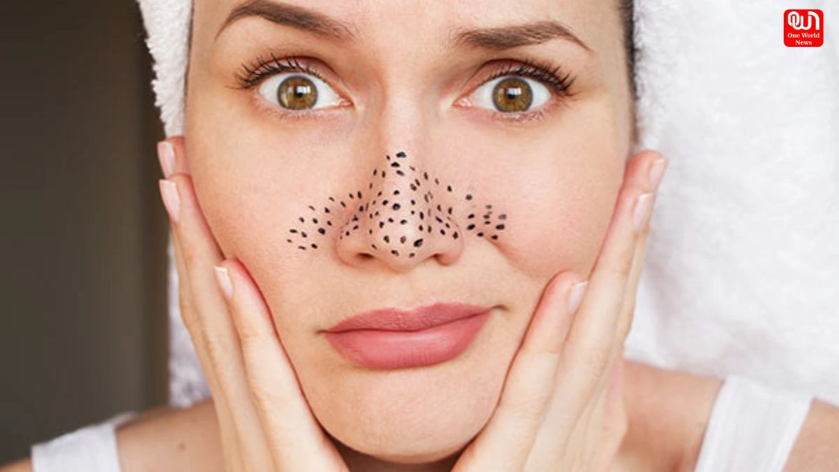 Black heads removal : फेस केयर के लिए 5 घरेलू नुस्खे, ब्लैकहेड्स को कहें अलविदा 1 Black heads removal