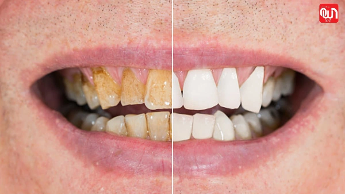 Plaque : दांतों पर जमी गंदगी हो जाएगी साफ, मुंह की बदबू भी होगी गायब! डॉ ने बतया दांतों का इलाज 1 Plaque