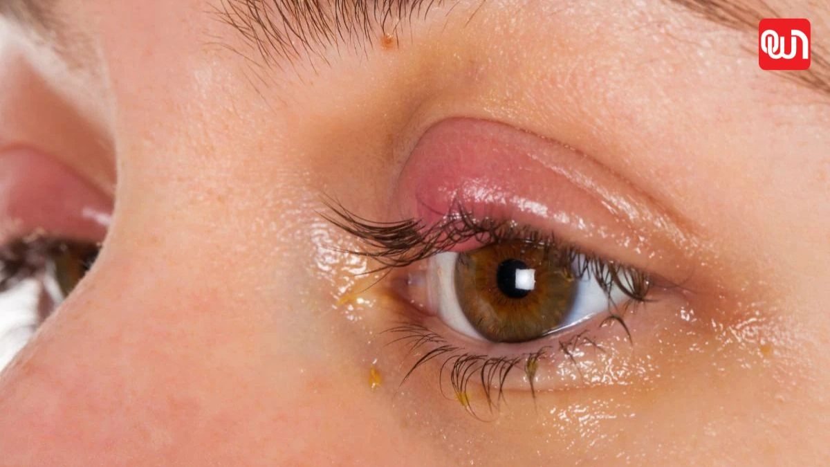 Itchy Eyes Treatment: घर पर करें आंखों की खुजली का इलाज, आसान और सुरक्षित उपाय 1 Itchy Eyes Treatment