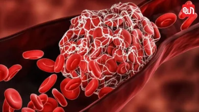 World Thrombosis Day: विश्व थ्रॉम्बोसिस दिवस2025, खून के थक्के से जुड़े खतरों और सावधानियां 4 World Thrombosis Day