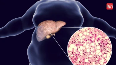 Grade 1 Fatty Liver: लिवर हेल्थ टिप्स, Grade 1 Fatty Liver में इन 3 बातों को नजरअंदाज करना पड़ सकता है भारी 8 Grade 1 Fatty Liver