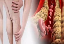 Unblock a blocked vein