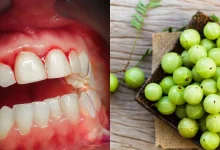 Amla benefits for bleeding gums