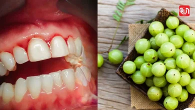 Amla benefits for bleeding gums