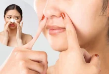 Blackheads Home Remedies