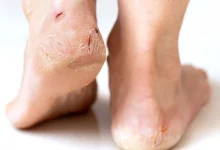 Cracked Heels Treatment