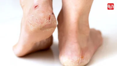 Cracked Heels Treatment