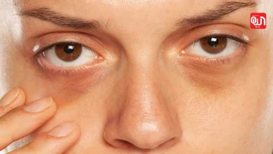 Dark Circles Home Remedy