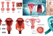 Early detection of cervical cancer