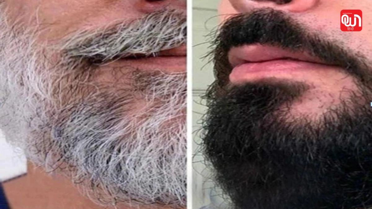 White beard turn black naturally: क्या सफेद दाढ़ी फिर से काली हो सकती है? जानिए कारण और प्राकृतिक उपाय 1 White beard turn black naturally