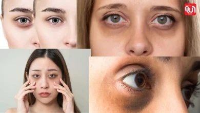 home remedies for dark circles