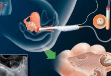 How long does it take to get pregnant through IVF