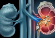 Kidney stone recurrence