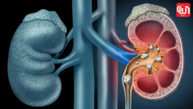 Kidney stone recurrence: पानी कम पीना पड़ सकता है भारी! किडनी स्टोन दोबारा बनने की वजहें 10 Kidney stone recurrence