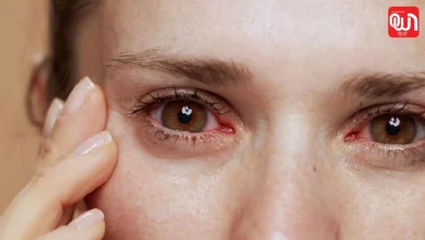 Dry Eye Disease
