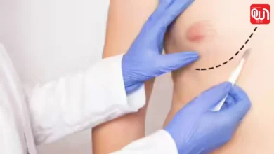 Male Breast Cancer