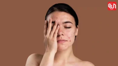Pigmentation On Face