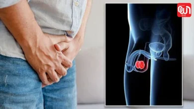 Testicular Cancer