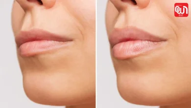Think before getting lip filler