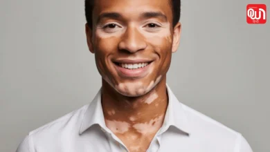 World Vitiligo Day 2026