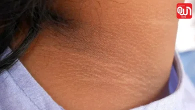 Dark Neck Home Remedy