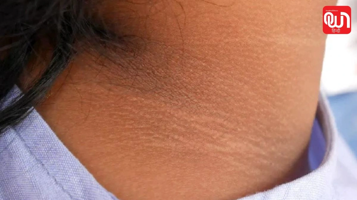 Dark Neck Home Remedy: सिर्फ 2 चीजों से दूर करें गर्दन की गंदगी और कालापन, जानें कैसे 1 Dark Neck Home Remedy