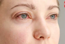 Dry Eye Syndrome