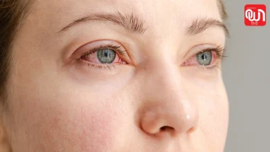 Dry Eye Syndrome