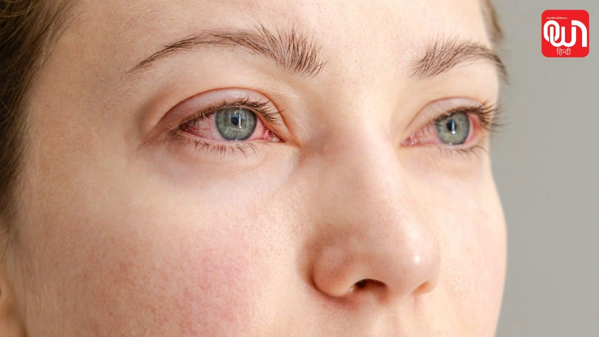 Dry Eye Syndrome: स्क्रीन देखने से बढ़ रही है आंखों की परेशानी, जानें 20-20-20 रूल का फायदा 1 Dry Eye Syndrome