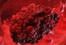 Blood Clots