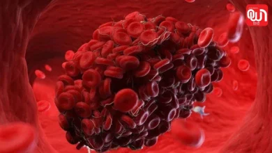 Blood Clots