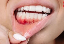 Oral Cancer Symptoms