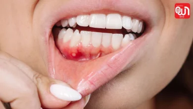 Oral Cancer Symptoms