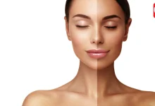 Tanning Removal