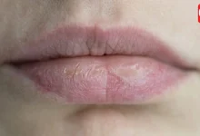 Chapped Lips Remedies