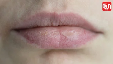 Chapped Lips Remedies