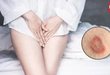 Skin Infection