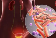 Urinary Tract Infection