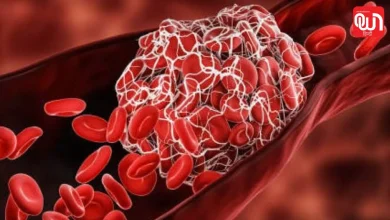 World Thrombosis Day 2026: खून का थक्का बनने के कारण, लक्षण और बचाव की पूरी जानकारी 8 World Thrombosis Day 2026