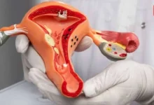 Non Surgical Fibroid