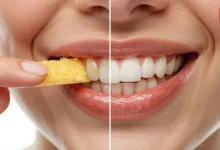Tooth Sensitivity