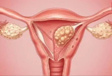 Uterine Fibroids