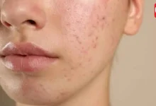 Skin Barrier