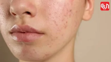 Skin Barrier