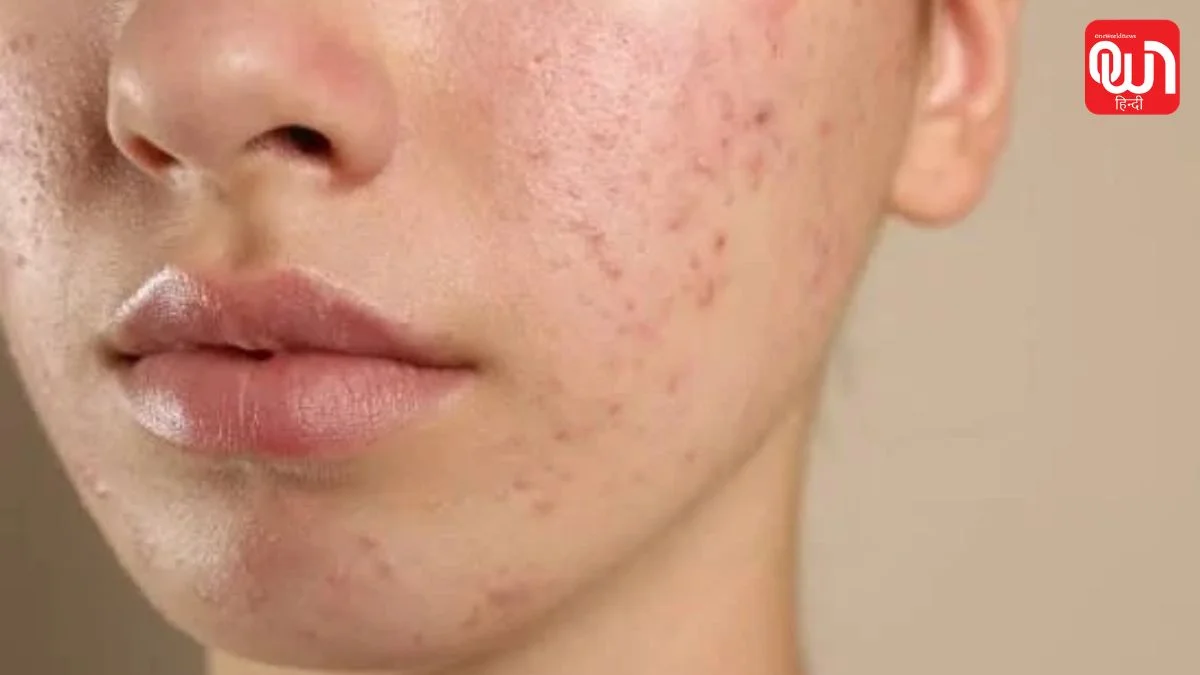 Skin Barrier: चेहरे पर छोटे दाने और Flaking? हो सकते हैं Skin Barrier Damage के संकेत 1 Skin Barrier