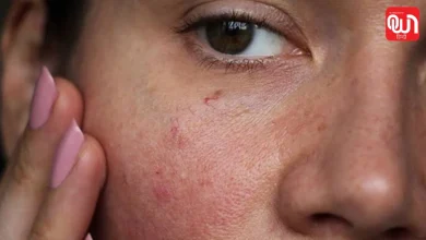 स्किनकेयर में कर रहे हैं ये गलती? चेहरे पर दिख सकते हैं Over-Exfoliation के ये लक्षण 1 Over-Exfoliation