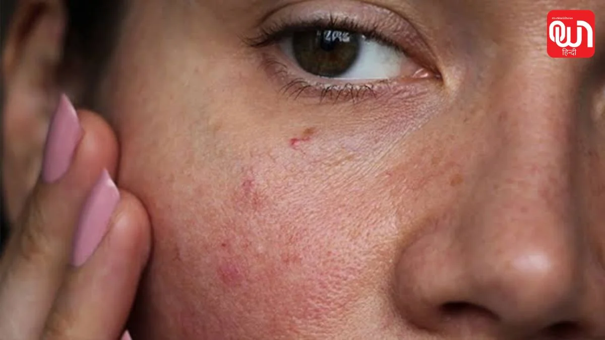 स्किनकेयर में कर रहे हैं ये गलती? चेहरे पर दिख सकते हैं Over-Exfoliation के ये लक्षण 1 Over-Exfoliation